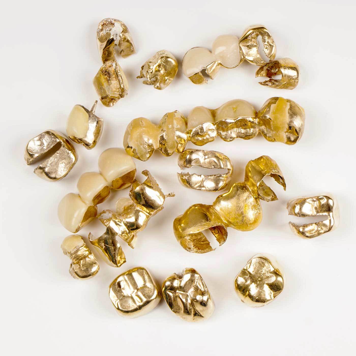 Nahaufnahme von Dentalgold und Zahngold, das zur Bewertung bereitliegt. Symbolisiert den Zahngoldankauf bei Goldhaus Lehmann. Das Bild zeigt verschiedene Goldstücke und Dentallegierungen, ideal für Kunden, die ihr Zahngold zu fairen Preisen verkaufen möchten.